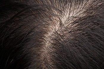 育毛における頭皮ケアの重要性